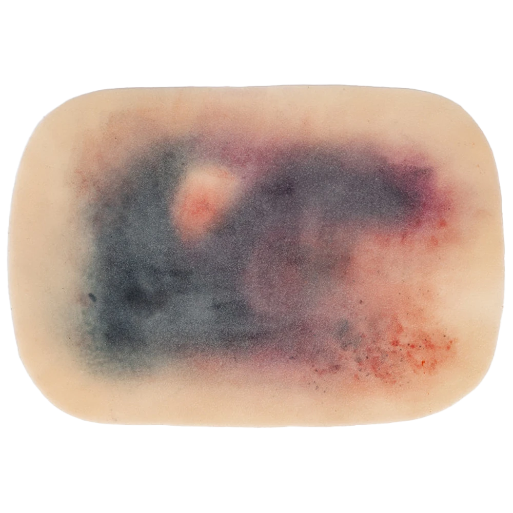 TraumaSim Self-Adhesive Large Haematoma